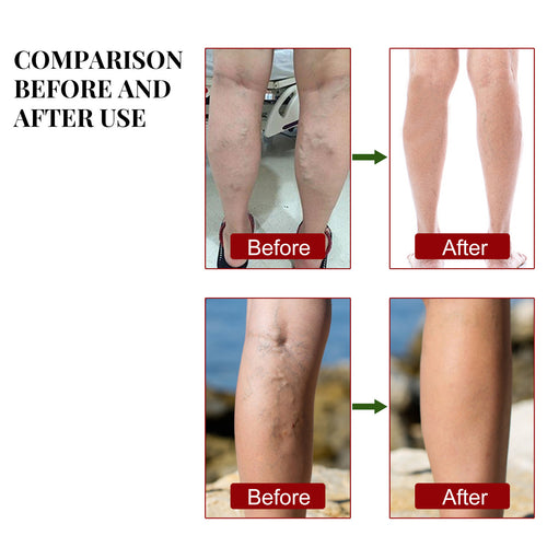 South Moon Herbal Patch for Leg Pain Relief and Care